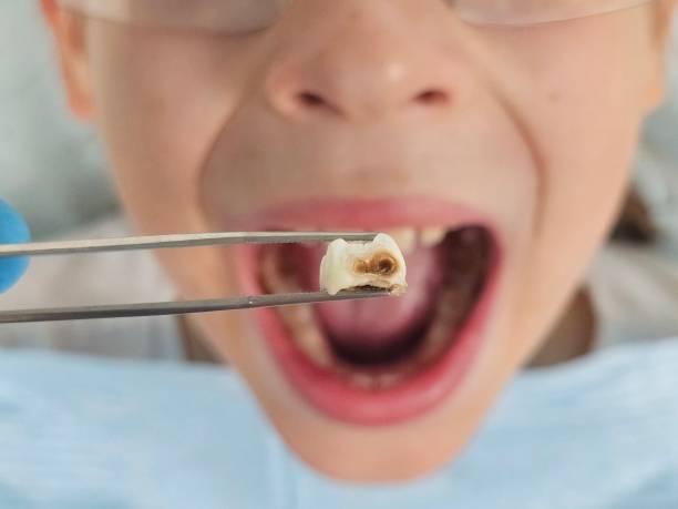 Best Chipped Tooth Repair Near Me  in Greentown, OH